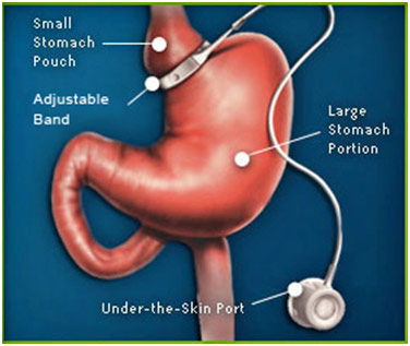 Lap Band Surgery illustration
